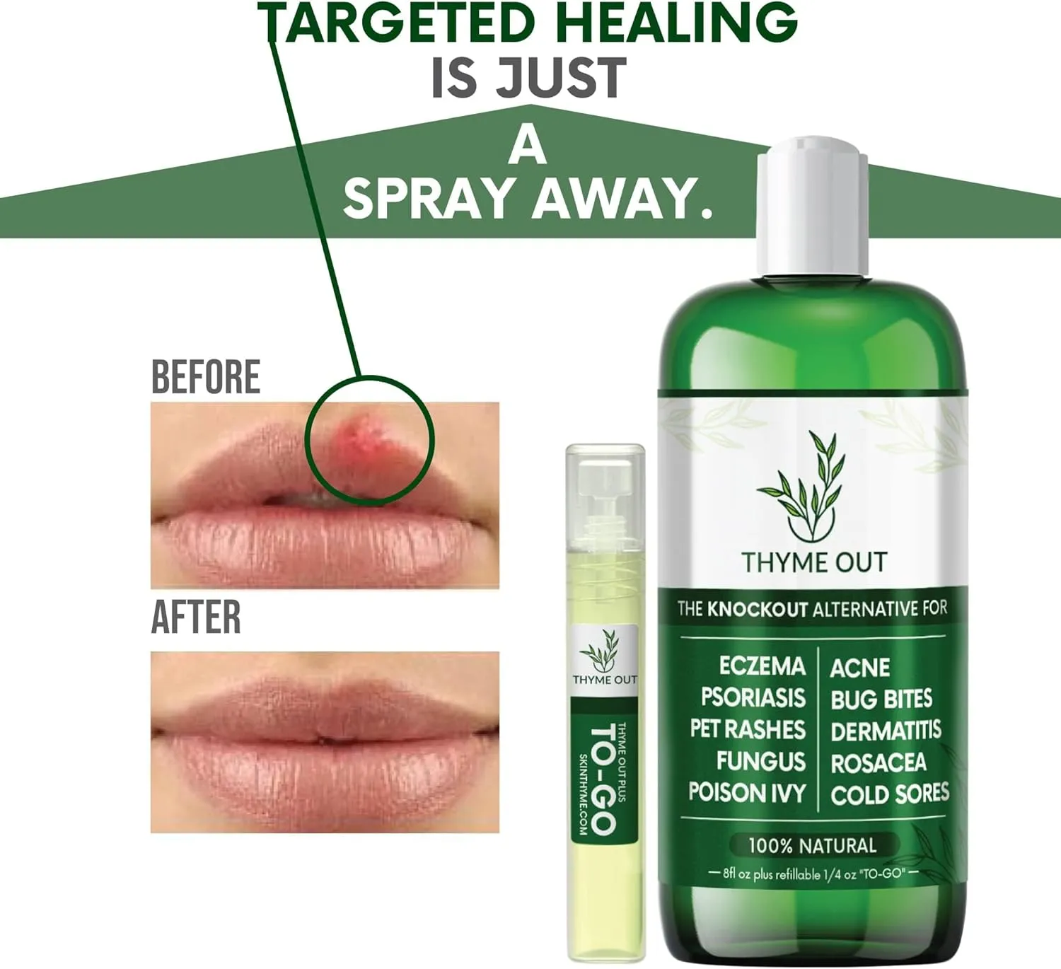 All Natural Eczema Treatment- Psoriasis Treatment - an All-in-One Solution for Acne, Dermatitis, Rosacea, Cold Sores, Pet Rashes, Bug Bites, and Poison Ivy - Anti-Itch Spray for Itchy Skin Relief