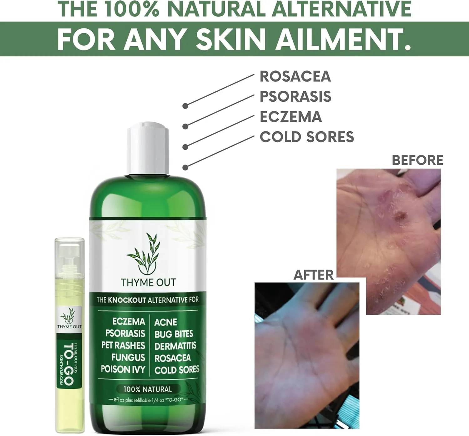 All Natural Eczema Treatment- Psoriasis Treatment - an All-in-One Solution for Acne, Dermatitis, Rosacea, Cold Sores, Pet Rashes, Bug Bites, and Poison Ivy - Anti-Itch Spray for Itchy Skin Relief